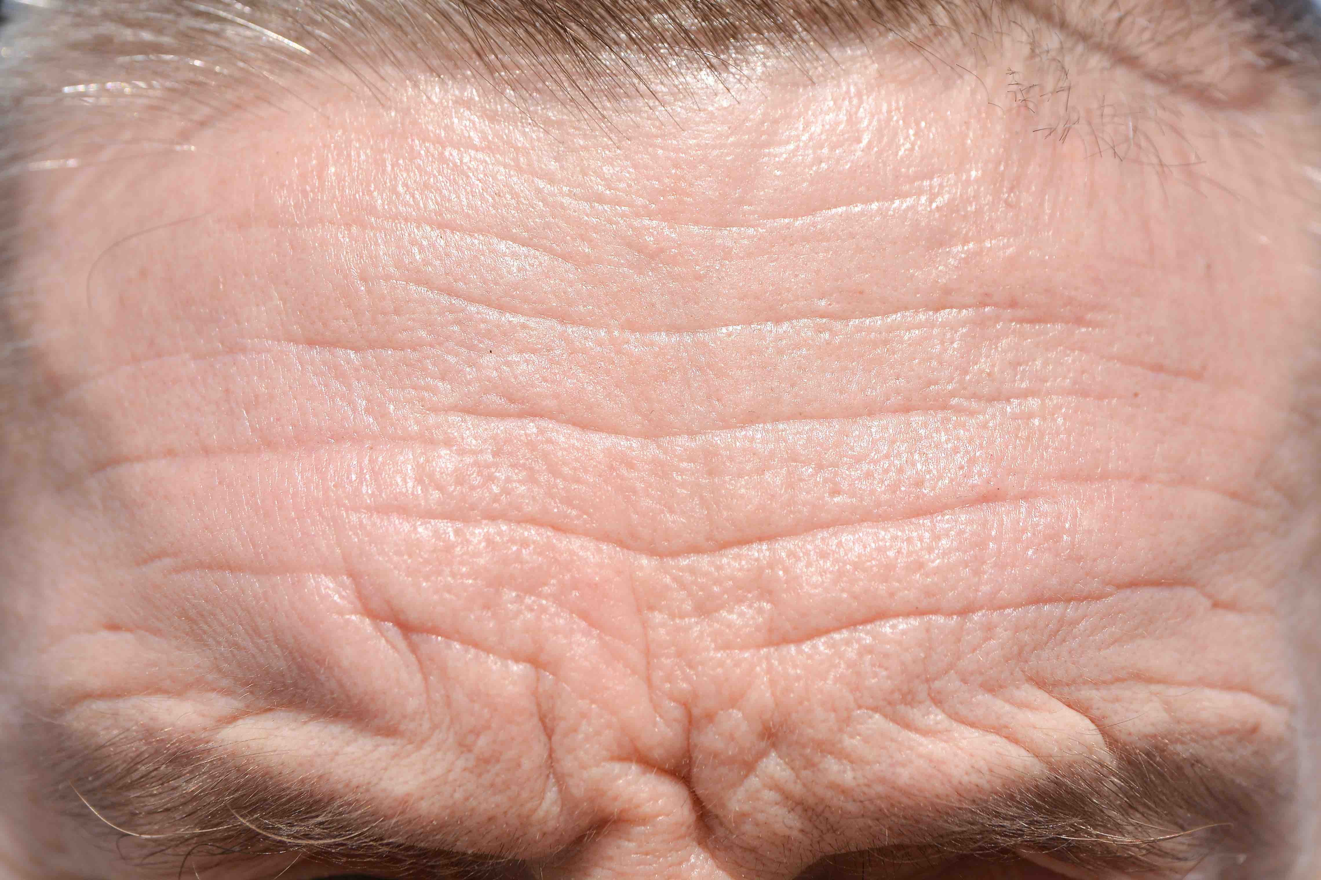 Forehead lines 